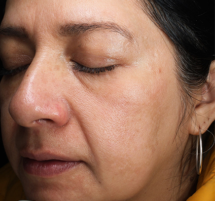 After | Skin Resurfacing | Hybrid